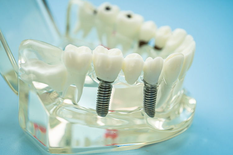 4 types of dental implants