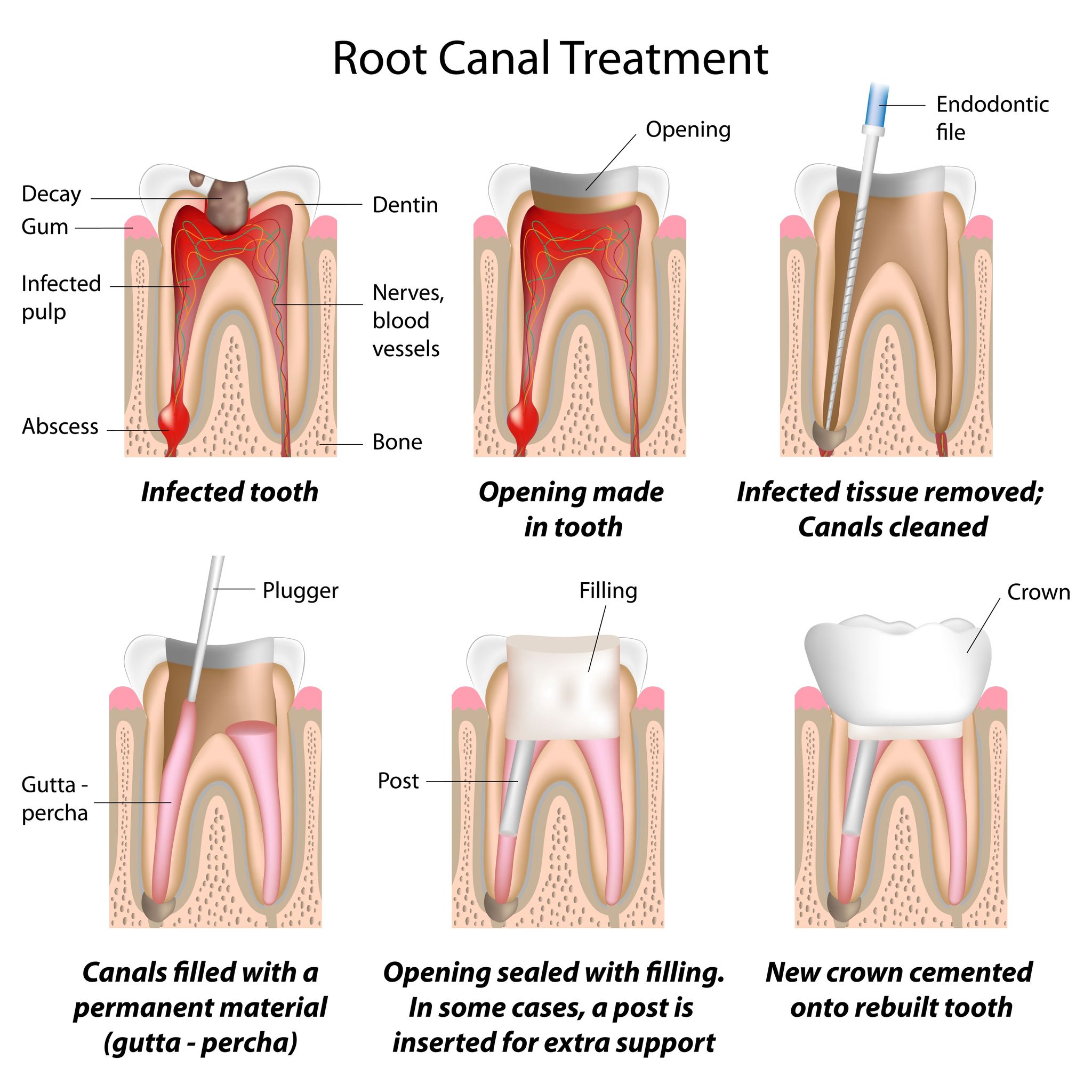 Ooltewah Root Canal